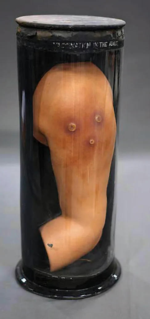 A Rare Collection Of Pre-Photography Teaching Aids: Housed in the Pathology Museum at Sir JJ Hospital, these late-19th-century wax moulages have survived epidemics, climate change and shifting medical practices. Made before clinical photography, they were vital teaching tools for skin diseases seen in Bombay. Depicting conditions such as secondary syphilis, adult vaccination reactions, psoriasis, eczema, rheumatoid joints and more, they were used to train students to read colour, texture and distribution at a time when careful observation was the foundation of diagnosis.